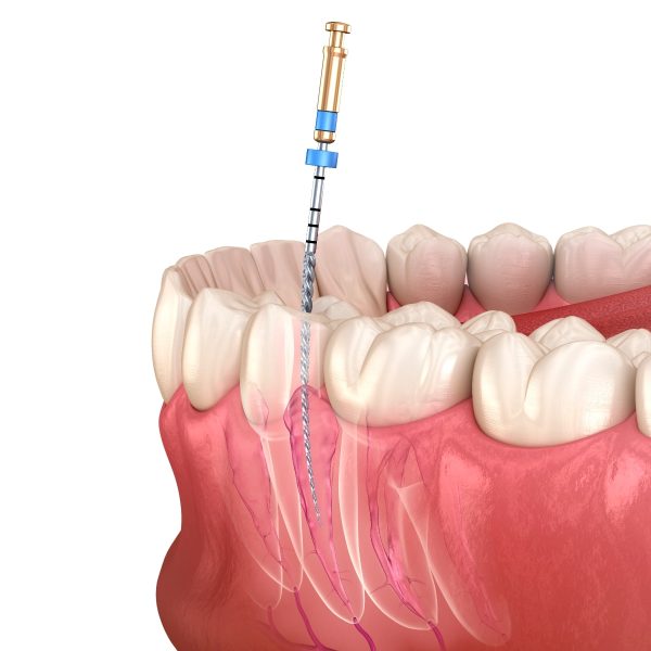 Endodoncia Smile Me