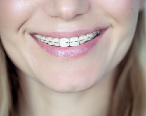 Ortodoncia Brackets Esteticos Smile Me