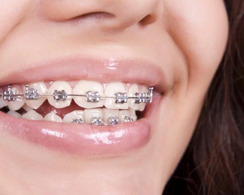 Brackets Metálicos En Alcobendas