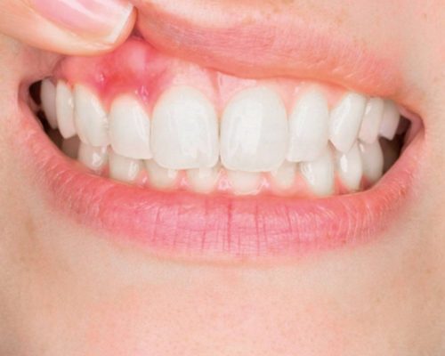 Tratamientos Periodoncia 1500x630