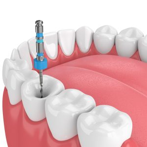 Cuándo Es Necesaria Una Endodoncia