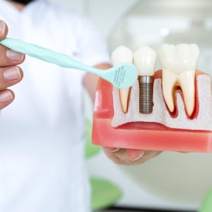 Implantes Dentales