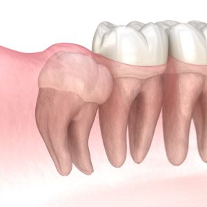 Dientes Retenidos