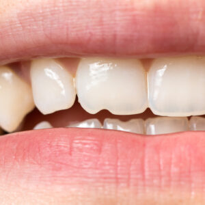 señales de desgaste dental
