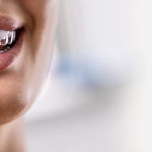 Dientes Alineados 6 Meses