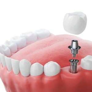 Implantes Dentales