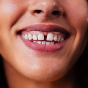diastemas dentales