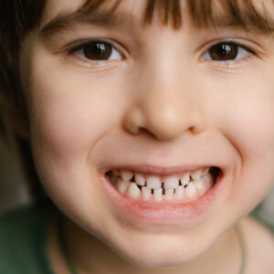 Close Up Headshot Of Little Preschool Cute Boy Widely Smiling, Showing The First Baby Milk Teeth. Happy Four Or Five Years Old Small Adorable Cutie Toddler With Primary Teeth. Portrait.