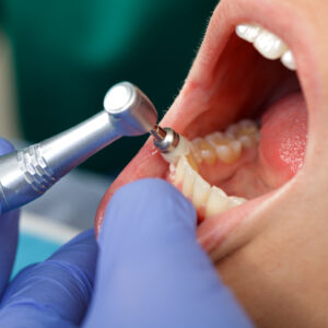 Professional Dental Brushing
