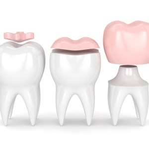 Reconstrucción Dental
