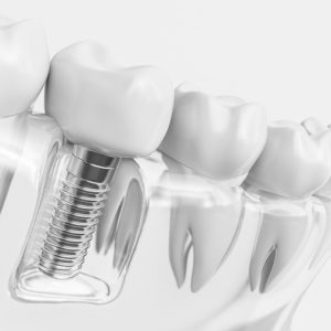 Rechazo Implante Dental